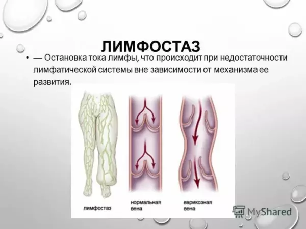 Лимфостаз